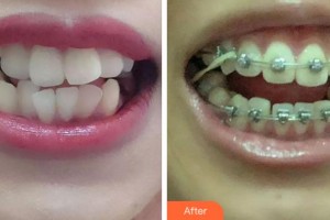 紹興博雅口腔醫(yī)院何章良整形價(jià)格表附金屬托槽矯正案例展示