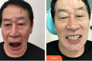 紹興博雅口腔醫(yī)院金燦新整形價(jià)格表附種植牙案例展示