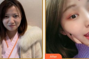 紹興愛爾眼科醫(yī)院周玲芬整形價(jià)格表附眼部綜合案例展示