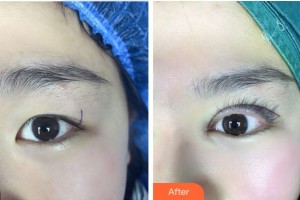 紹興愛爾眼科醫(yī)院郭雪琴整形價(jià)格表附眼部綜合案例展示