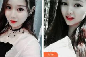 紹興越中口腔醫(yī)院蔡玉玲整形價(jià)格表附牙齒隱形矯正案例展示