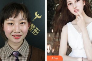 紹興市口腔醫(yī)院張志明整形價(jià)格表附牙齒隱形矯正案例展示