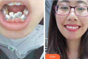 紹興市口腔醫(yī)院蔣建江整形價(jià)格表附金屬托槽矯正案例展示