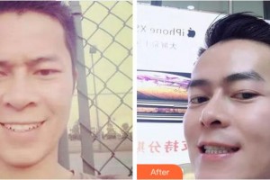 紹興市口腔醫(yī)院馮偉整形價(jià)格表附金屬托槽矯正案例展示