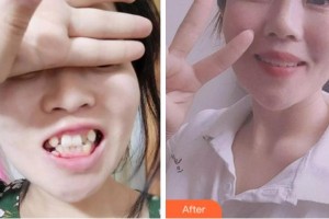 紹興京韓口腔醫(yī)院陳婷整形價(jià)格表附金屬托槽矯正案例展示