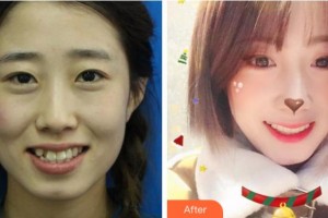 紹興京韓口腔醫(yī)院金力峰整形價格表附金屬托槽矯正案例展示