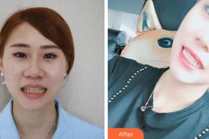 紹興博雅口腔醫(yī)院何淼鑫整形價格表附美白劑美白牙齒案例展示