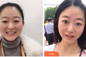 紹興博雅口腔醫(yī)院朱騰飛整形價格表附牙齒隱形矯正案例展示