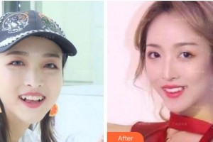 紹興博雅口腔醫(yī)院黃海波整形價格表附隱形托槽矯正案例展示