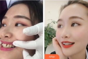 紹興博雅口腔醫(yī)院侯依桐整形價格表附隱形托槽矯正案例展示