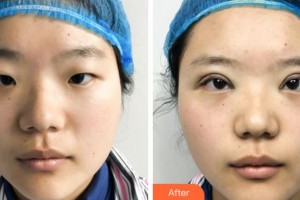 紹興袍江醫(yī)院眼科李田整形價格表附眼部綜合案例展示