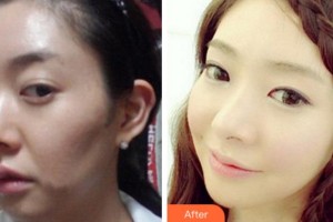 金華亞美整形美容醫(yī)院黃耀主整形價格表附埋線提升案例展示