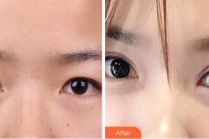 金華芘麗芙（原華美）整形醫(yī)院吳朔凡整形價(jià)格表附切開(kāi)雙眼皮案例展示