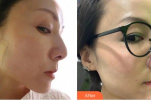 金華維多利亞美容醫(yī)院趙亮整形價(jià)格表附埋線提升案例展示