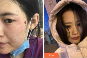 金華美辰醫(yī)療美容醫(yī)院徐伶愛(ài)整形價(jià)格表附激光美膚激光案例展示