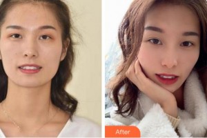 金華美辰醫(yī)療美容醫(yī)院蔡中整形價(jià)格表附牙齒隱形矯正案例展示