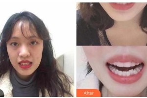 金華美辰醫(yī)療美容醫(yī)院越勇祥整形價(jià)格表附牙齒隱形矯正案例展示