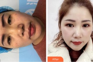 金華康美醫(yī)療美容綜合門(mén)診部孫傳整形價(jià)格表附定點(diǎn)雙眼皮案例展示