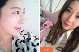 金華杭嬰整形美容外科診所朱杭嬰整形價(jià)格表附眼部綜合案例展示