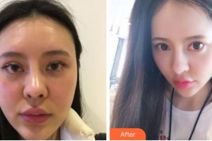 金華三星(原協(xié)和)整形醫(yī)院彭愛(ài)芳整形價(jià)格表附埋線提升案例展示