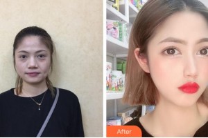 金華維多利亞美容醫(yī)院伊劍蘭整形價(jià)格表附埋線提升案例展示