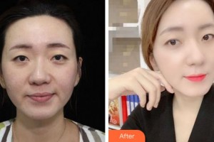 金華亞美整形美容醫(yī)院葉彩娣整形價(jià)格表附熱拉提案例展示