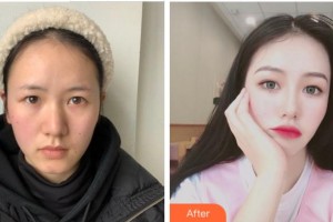 金華李丹醫(yī)療整形美容診所李丹整形價(jià)格表附雙眼皮案例展示