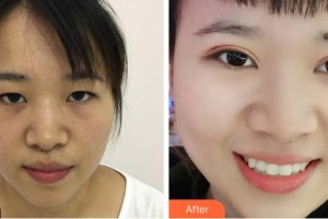 金華康美醫(yī)療美容綜合門(mén)診部劉興權(quán)整形價(jià)格表附定點(diǎn)雙眼皮案例展示