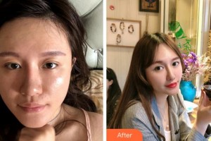 金華康美醫(yī)療美容綜合門(mén)診部洪鋼整形價(jià)格表附埋線提升案例展示