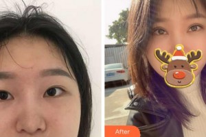 金華美辰醫(yī)療美容醫(yī)院胡華兵整形價格表附眼部綜合案例展示