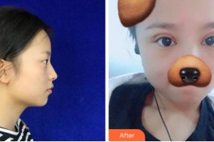 金華愛爾眼科醫(yī)院杜新華整形價格表附切開雙眼皮案例展示