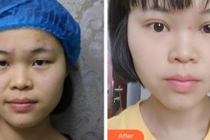 金華愛爾眼科醫(yī)院孫忠海整形價格表附切開雙眼皮案例展示