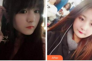 金華周亞軍口腔門診部張政通整形價格表附根管調節(jié)案例展示