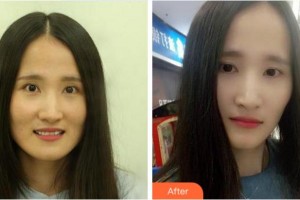 金華婁城口腔醫(yī)院史艷萍整形價格表附牙貼面案例展示