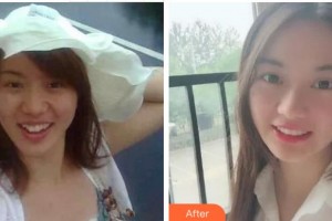 金華婁城口腔醫(yī)院傅安業(yè)整形價格表附金屬托槽矯正案例展示