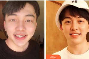 金華口腔醫(yī)院楊道路整形價格表附美白貼片案例展示