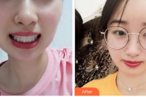 金華口腔醫(yī)院鄧靜艷整形價格表附牙齒隱形矯正案例展示