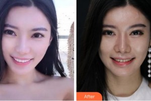 金華口腔醫(yī)院王麗君整形價格表附美白貼片案例展示