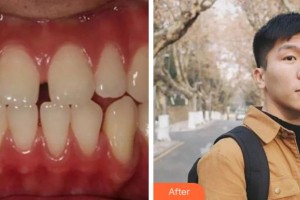 金華口腔醫(yī)院成曉敏整形價格表附金屬托槽矯正案例展示