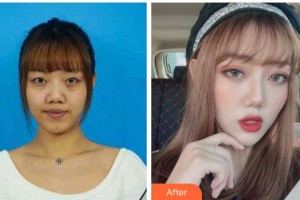 金華愛爾眼科醫(yī)院毛景璟整形價(jià)格表附切開雙眼皮案例展示