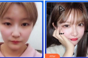 金華愛爾眼科醫(yī)院陳林勇整形價(jià)格表附埋線雙眼皮案例展示