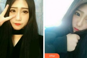 江蘇省口腔醫(yī)院于金華整形價(jià)格表附牙齒隱形矯正案例展示