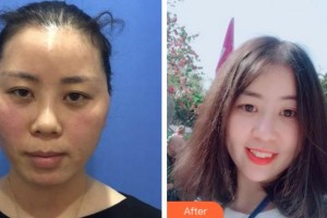 衢州美萊整形美容醫(yī)院袁帥整形價(jià)格表附埋線提升案例展示