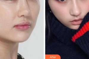 衢州美萊整形美容醫(yī)院劉富華整形價(jià)格表附埋線提升案例展示