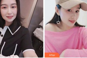 衢州市中醫(yī)院整形美容科楊順江整形價(jià)格表附埋線提升案例展示