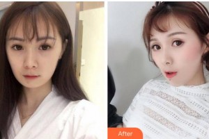 衢州民康醫(yī)院赫爾希整形美容中心胡謹(jǐn)整形價(jià)格表附埋線提升案例展示