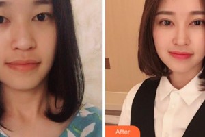 衢州芘麗芙整形美容醫(yī)院洪毓整形價(jià)格表附切開雙眼皮案例展示