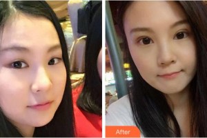 衢州芘麗芙整形美容醫(yī)院楊天明整形價(jià)格表附眼部綜合案例展示