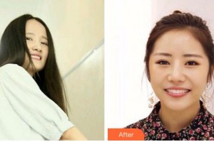 衢州口腔醫(yī)院李婉整形價(jià)格表附牙齒隱形矯正案例展示