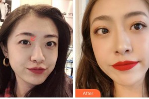 衢州愛爾眼科醫(yī)院荊樹棟整形價(jià)格表附眼部綜合案例展示